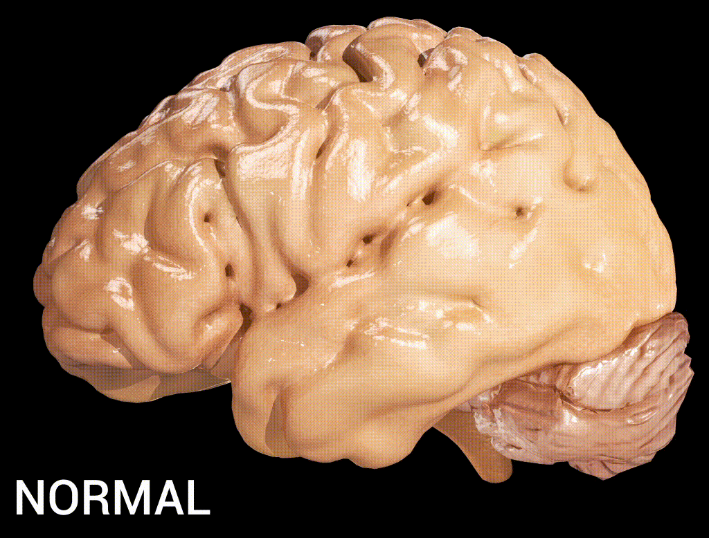 Diseases brain by Doctor Jana - CC BY 4.0
