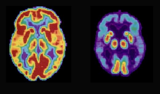 PET scan brain  image by Health and Human Services Department NIH_Public Domain