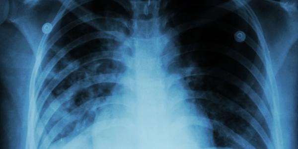 A chest x-ray of a person with pulmonary tuberculosis. Image by Puwadol Jaturawutthichai via Shutterstock.