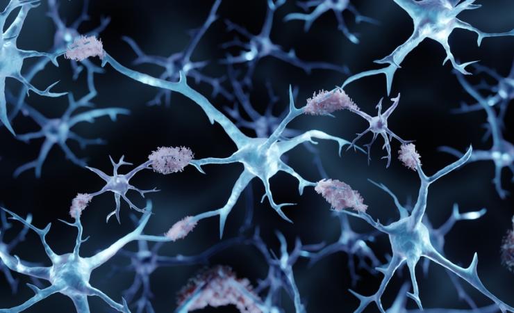 Amyloid plaques in a brain with Alzheimer's disease. Image credit: ART-ur