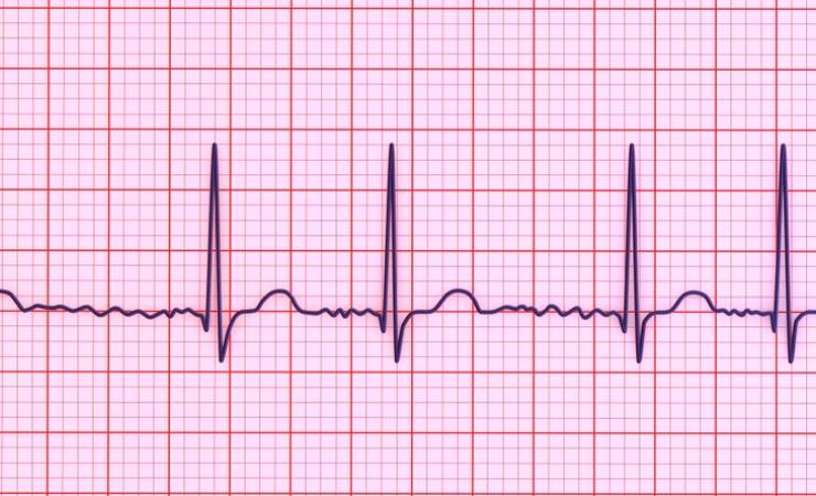 Electrocardiogram showing atrial fibrillation, a heart condition that can lead to stroke & heart failure