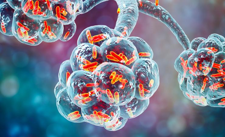 Bacterial pneumonia in the alveoli of the lungs. Image credit: Dr Microbe via Adobe Stock. 