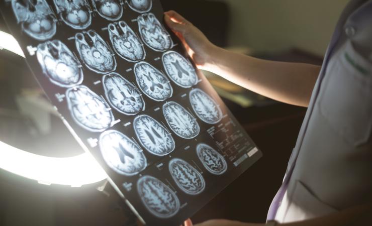 Researcher looking at a brain scane. Image credit: Atthapon Raksthaput