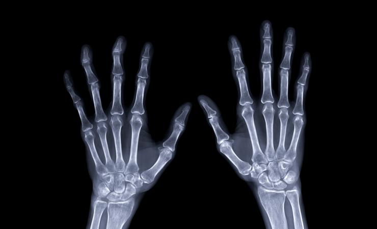 An x-ray of a pair of hands. Image by Radiological Imaging via Shutterstock.