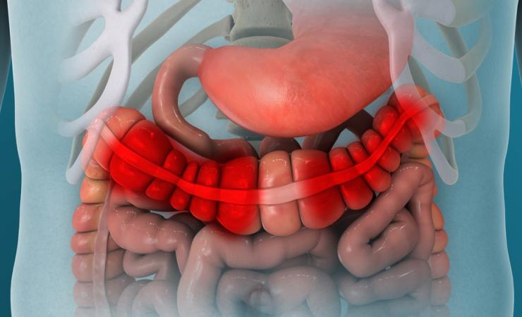 Inflammatory bowel disease. Image credit: Nathan Devery via Shutterstock.