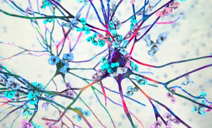 Lupus may affect any organ of the body. Here a brain cell is being attacked by the body's own antibodies. Image credit: Kataryna Kon via Shutterstock.