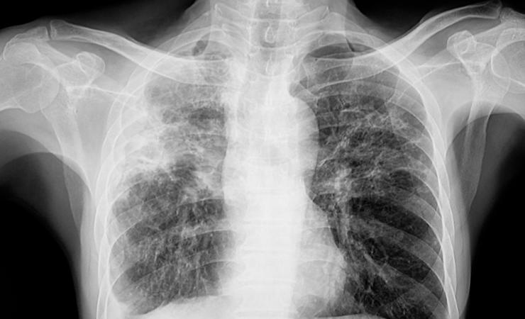 Chest x-ray of a person with pulmonary tuberculosis (TB); new treatments are now in clinical trials.