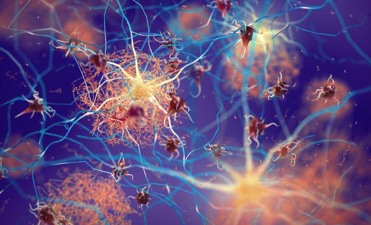 Amyloid plaques forming in a brain with Alzheimer's. Image credit: Nobeastsofierce via Shutterstock. 