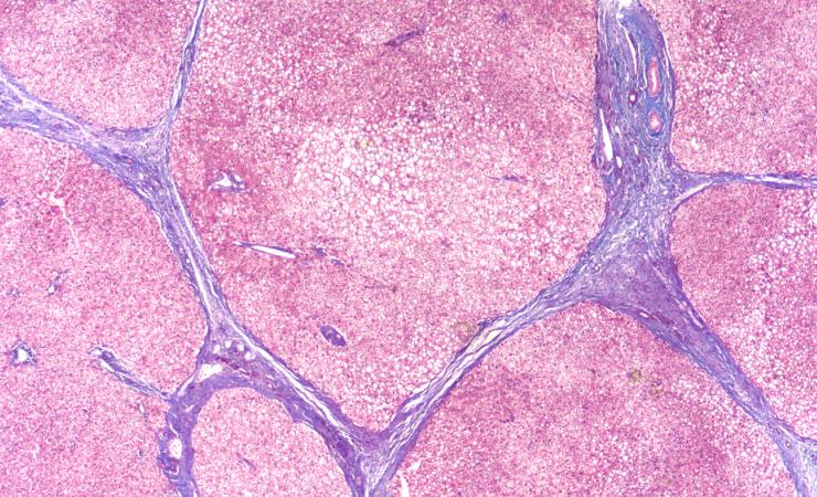 Photomicrograph of liver biopsy in a patient with cirrhosis. Image by David A. Litman via Shutterstock.