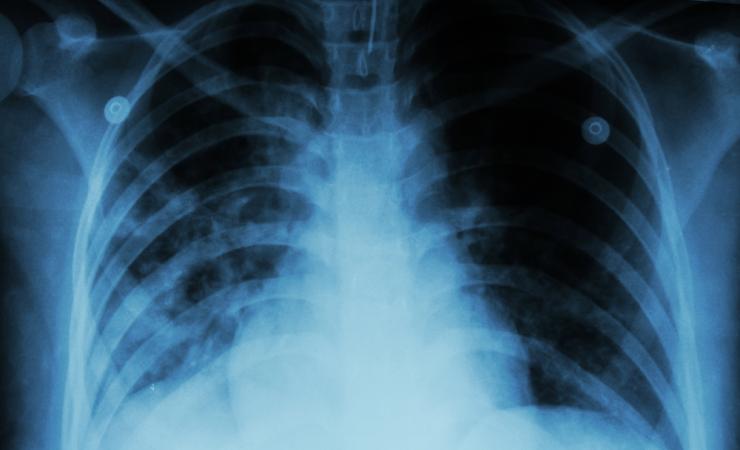 A chest x-ray of a person with pulmonary tuberculosis. Image by Puwadol Jaturawutthichai via Shutterstock.