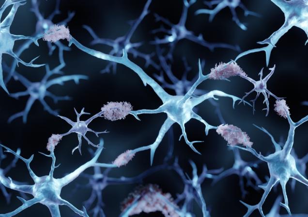 Amyloid plaques in a brain with Alzheimer's disease. Image credit: ART-ur