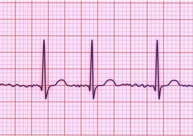 Electrocardiogram showing atrial fibrillation, a heart condition that can lead to stroke & heart failure. Image Kateryna Kon, Shutterstock