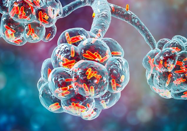 Bacterial pneumonia in the alveoli of the lungs. Image credit: Dr Microbe via Adobe Stock. 