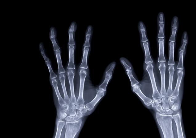 An x-ray of a pair of hands. Image by Radiological Imaging via Shutterstock.