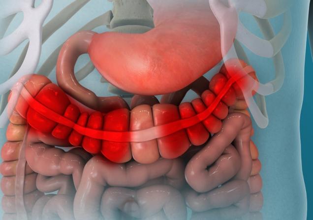Inflammatory bowel disease. Image credit: Nathan Devery via Shutterstock.