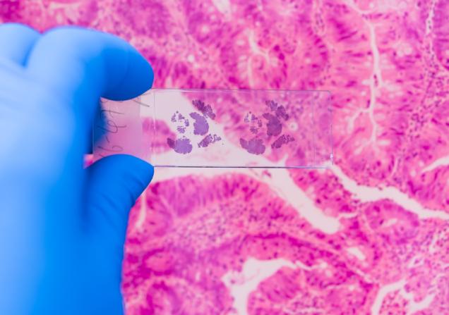 Scientist viewing breast cancer cells on slide. Image by Komsan Loonprom via Shutterstock