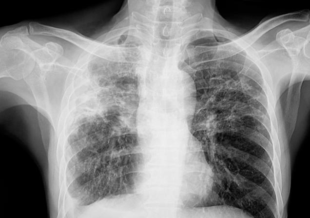Chest x-ray of a person with pulmonary tuberculosis (TB); new treatments are now in clinical trials.