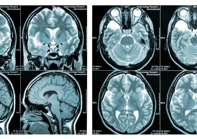 Brain with MS. Image courtesy of Campoloma via Shutterstock.