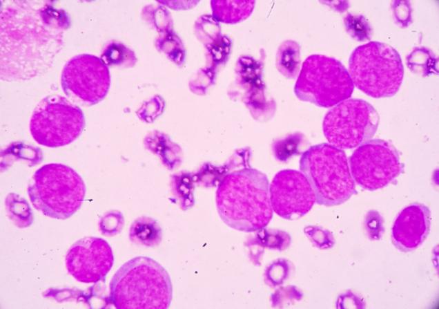 Abnormal blood cells in a patient with a type of blood cancer called AML. Image by Medtech THAI STUDIO LAB 249 via Shutterstock