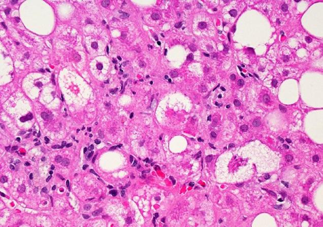 Liver tissue showing signs of NAFLD. Image by Dr David Kleiner, National Cancer Institute, NIH.