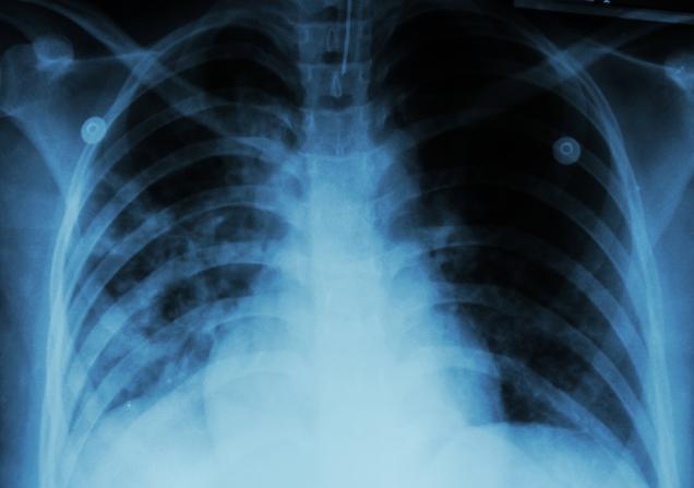 A chest x-ray of a person with pulmonary tuberculosis. Image by Puwadol Jaturawutthichai via Shutterstock.