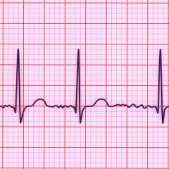 Electrocardiogram showing atrial fibrillation, a heart condition that can lead to stroke & heart failure