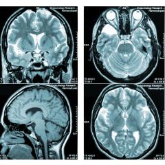 Brain with MS. Image courtesy of Campoloma via Shutterstock. Brain with MS. Image courtesy of Campoloma via Shutterstock.