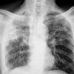 Chest x-ray of a person with pulmonary tuberculosis (TB); new treatments are now in clinical trials.
