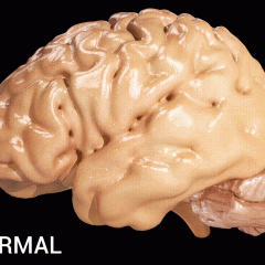 Image courtesy of Doctor Jana. CC BY 4.0 Alzheimer's Disease in the brain. Image courtesy of Doctor Jana. CC BY 4.0