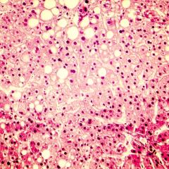 Fatty liver cells. Image by Kateryna Kon via Shutterstock