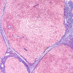 Photomicrograph of liver biopsy in a patient with cirrhosis. Image by David A. Litman via Shutterstock.