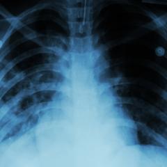 A chest x-ray of a person with pulmonary tuberculosis. Image by Puwadol Jaturawutthichai via Shutterstock.